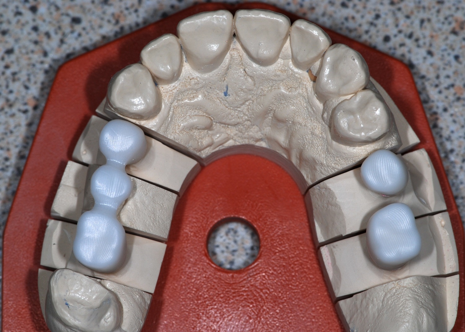 Couronnes sur implants, chapes zircone