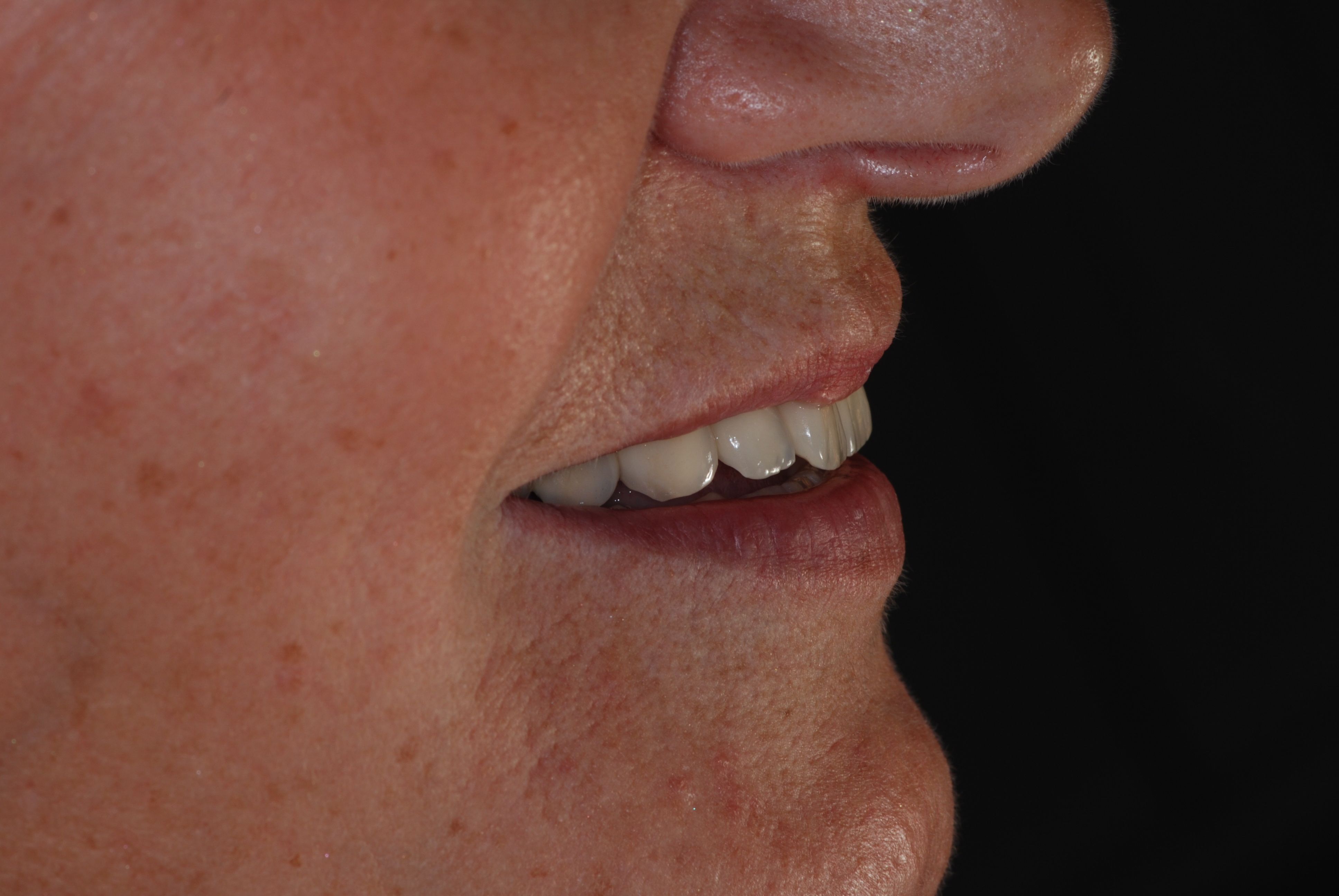 Implants, sourire, vue de profil