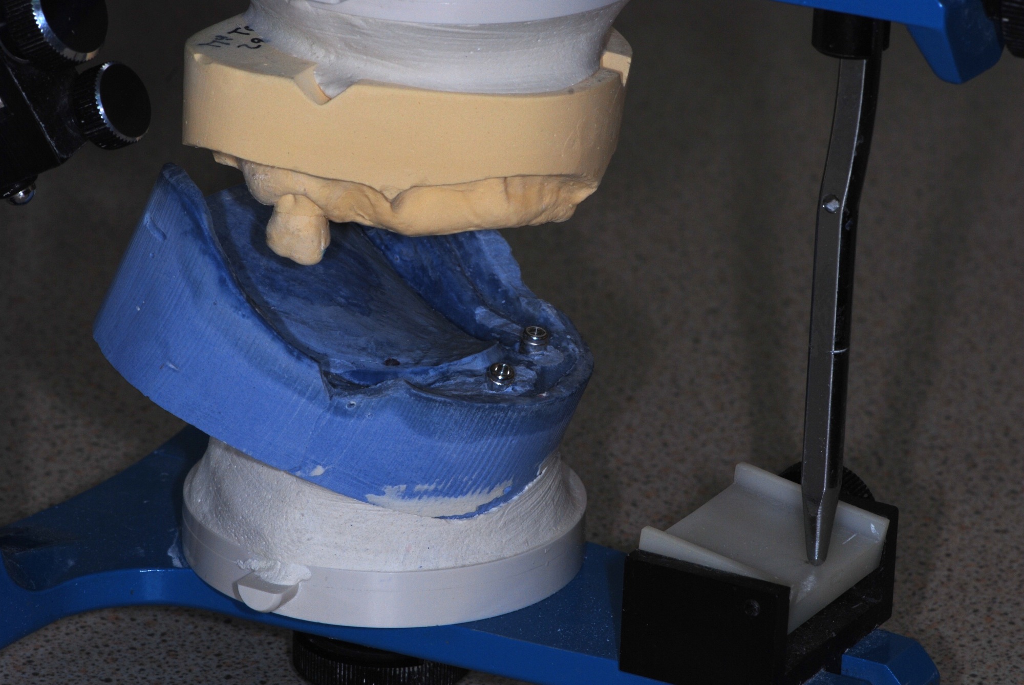 Modèles de laboratoires montés sur un simulateur des mouvements mandibulaires Prothèse amovible complète stabilisée par implants modèles