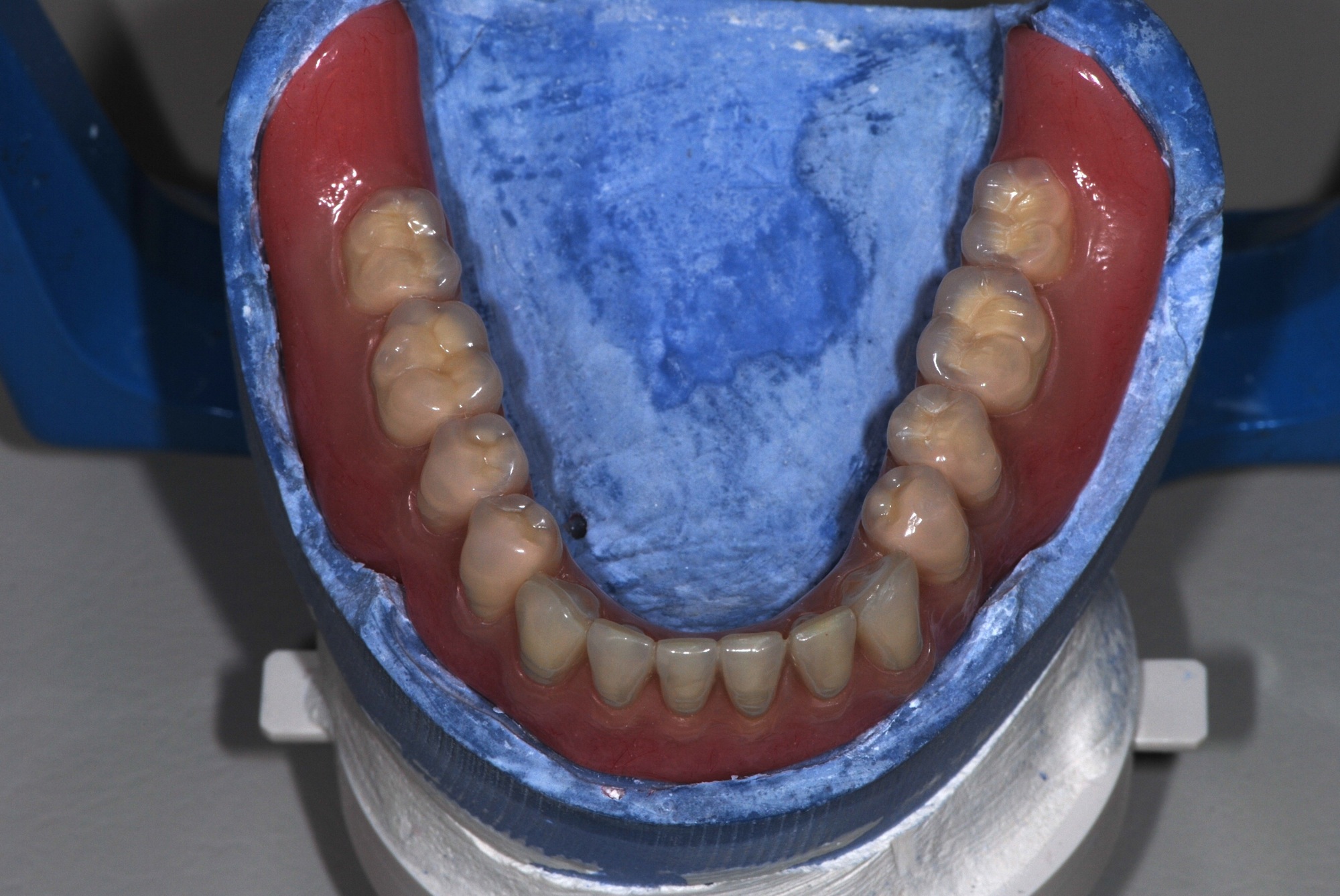 Prothèse mandibulaire Prothèse amovible complète stabilisée par implants, montage