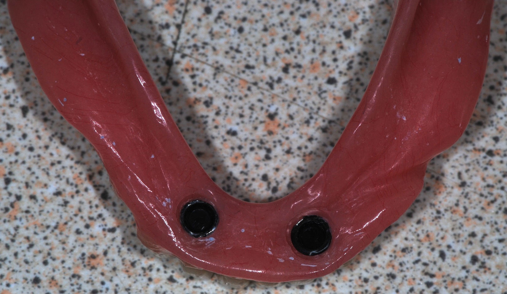 Vue de l'intrados avec les pièces de rétention femelles Prothèse amovible complète stabilisée par implants intrados